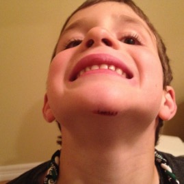 Ol' Six-Stitch Ted, after a run in with the monkey bars on the first day of summer break